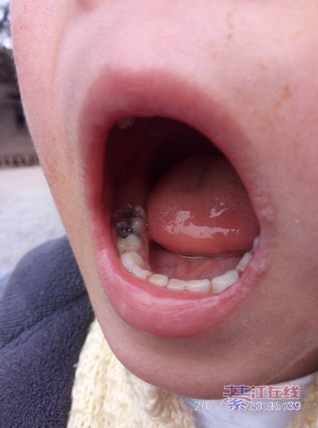 小孩虫牙真的有虫