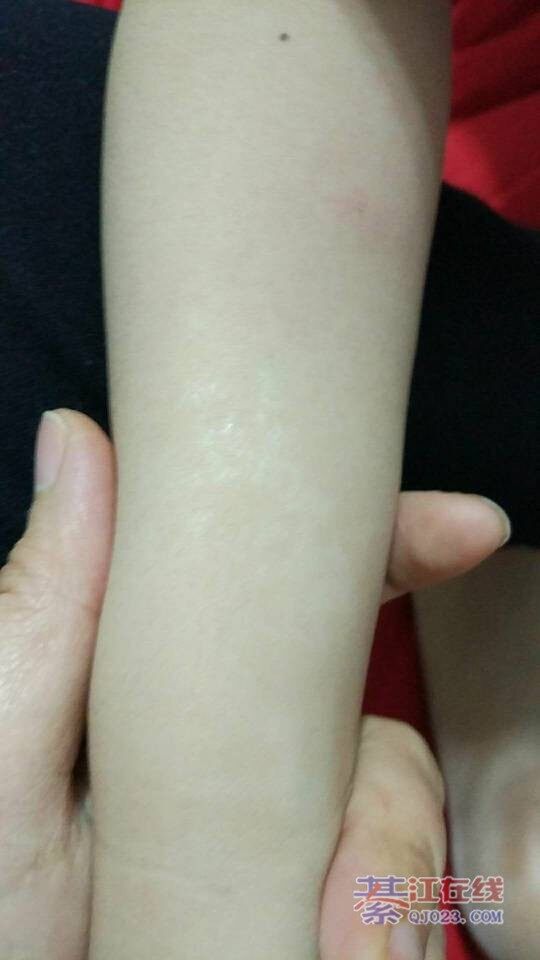 6岁的小孩腿上长了像线一样的白班,不晓得是什么