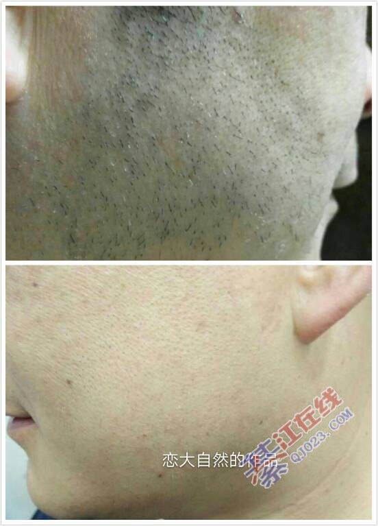 脱毛找我:恋.大自然